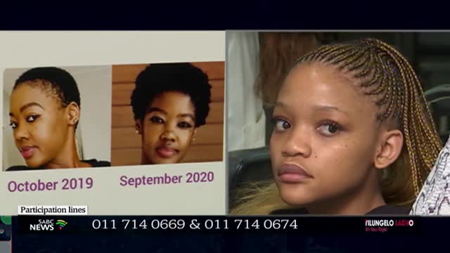 Understanding Alopecia